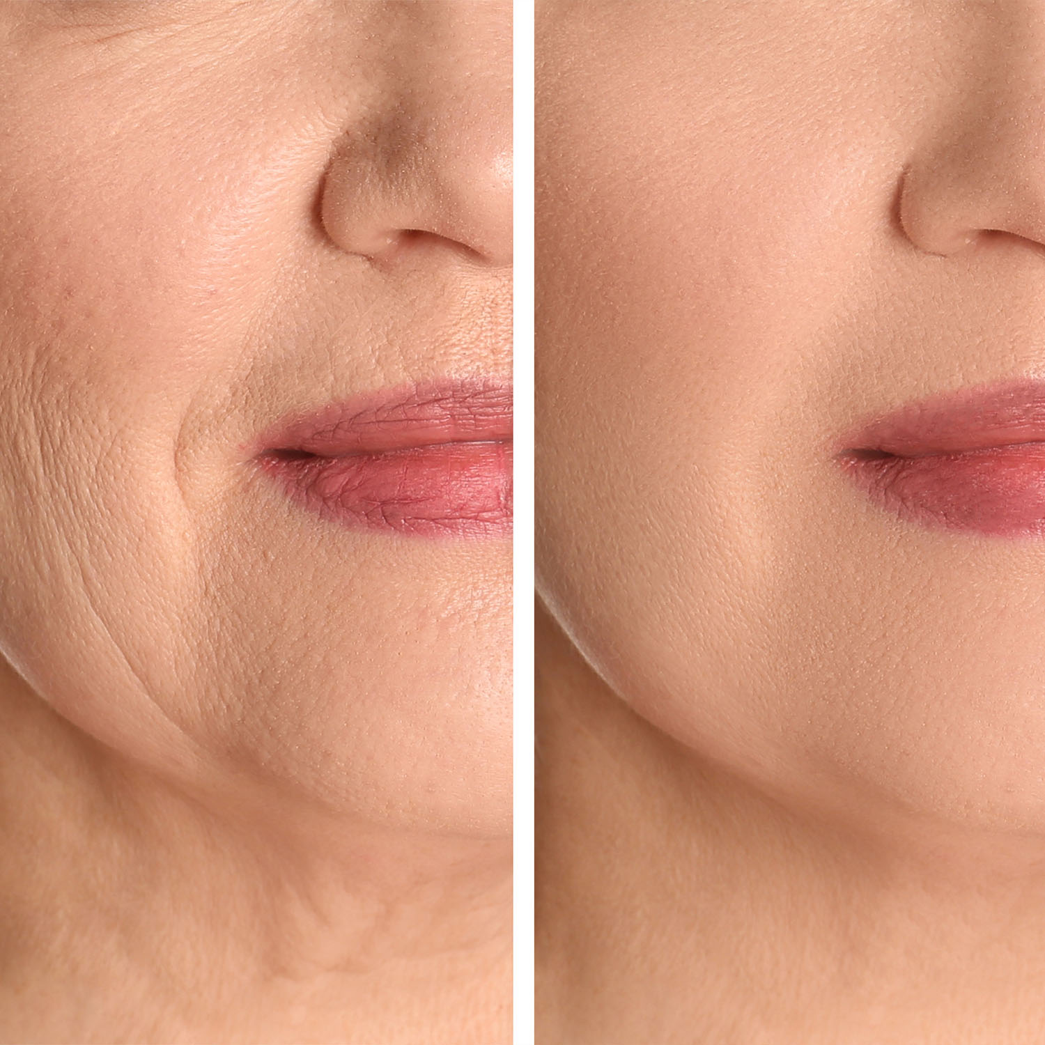 Microdermabrasion3 microdermabrasion3 - Microdermabrasion