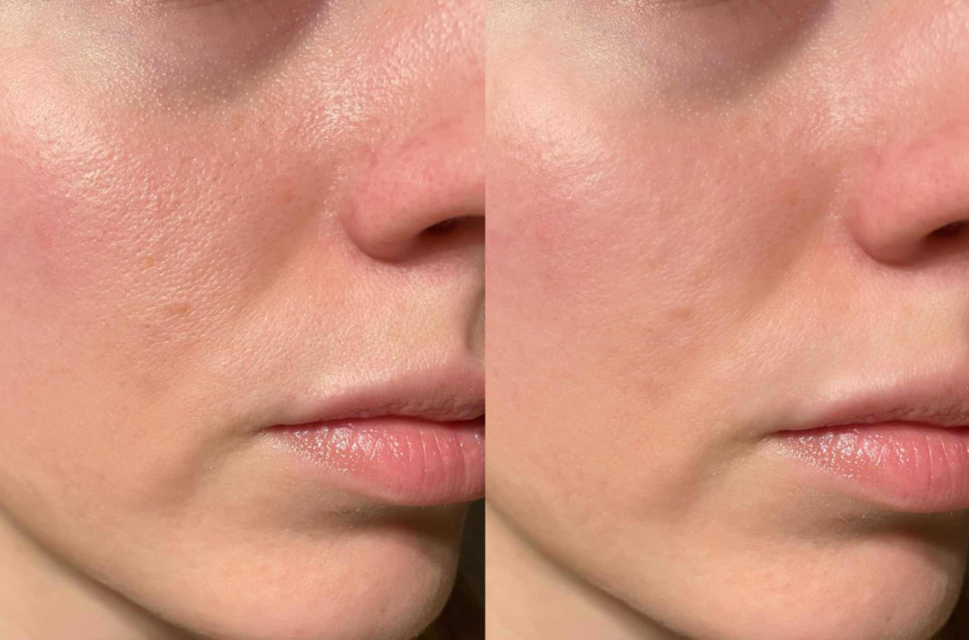 Microneedling1 microneedling1 1 - Microneedling